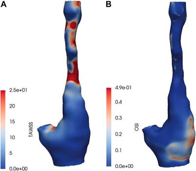 The Correlation Between Wall Shear Stress and Plaque Composition in Advanced Human Carotid Atherosclerosis